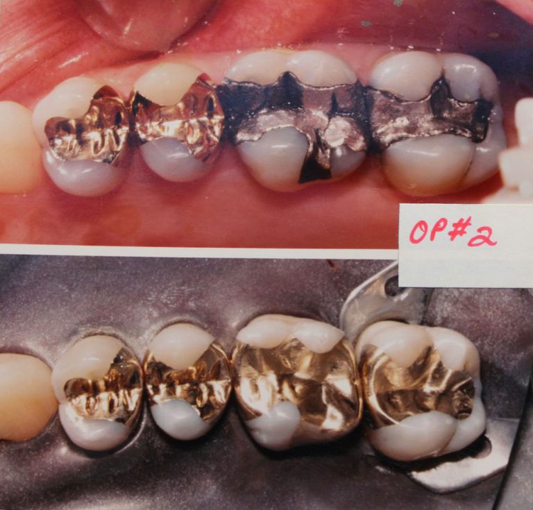 R.V. Tucker Gold Casting North Vancouver BC IQ Dental