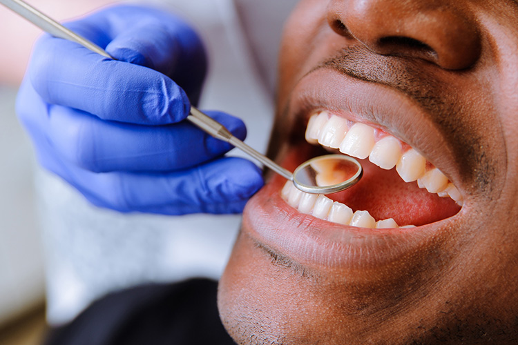 What Exactly is a Root Canal?
